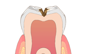 歯の表面（エナメル質）の虫歯